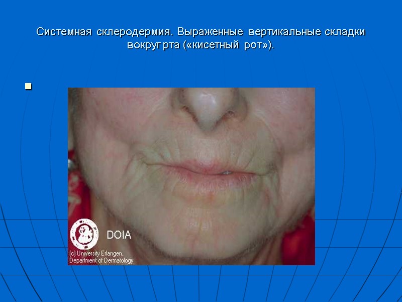 Системная склеродермия. Выраженные вертикальные складки вокруг рта («кисетный рот»).